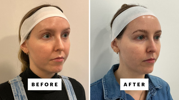 XERF Is the New Non-Invasive Skin-Tightening Device Gaining Popularity in the US, and I Tried It—Review, Photos